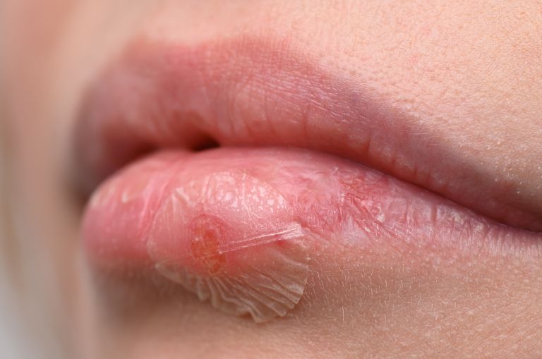 herpes2.jpg