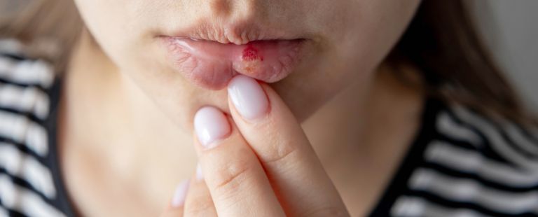 herpes3.jpg