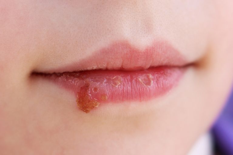 herpes.jpg