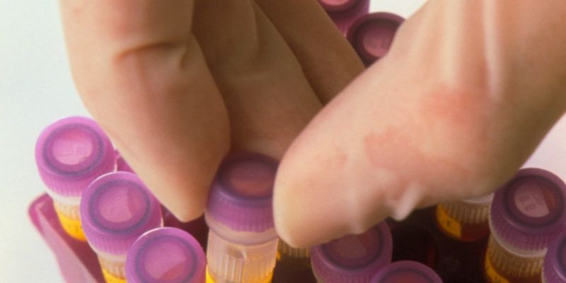 hepatitis c, hepatitis b, testiranje