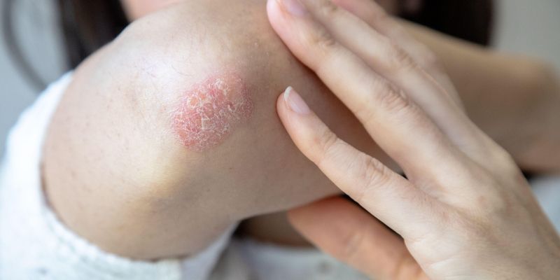 luskavica, suha koža