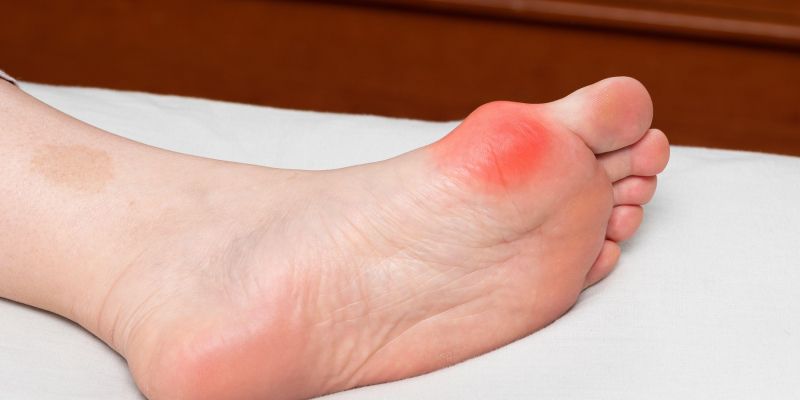 hallux valgus, izkrivljen nožni palec