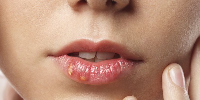 herpes, sonce