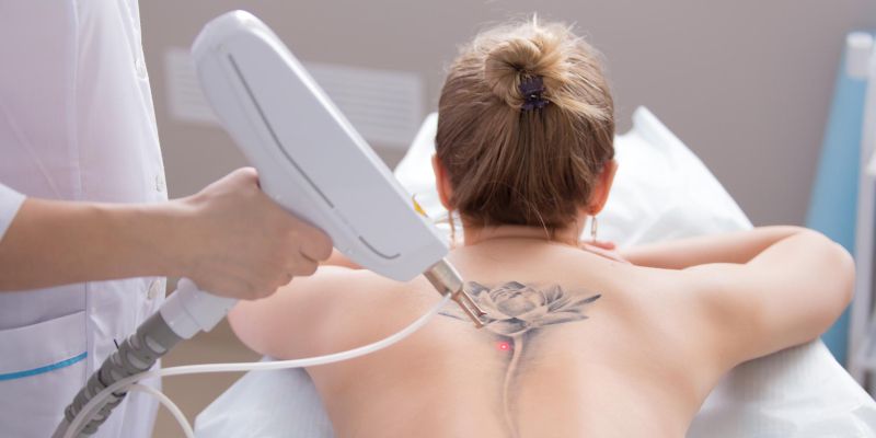 Odstranitev tetovaže