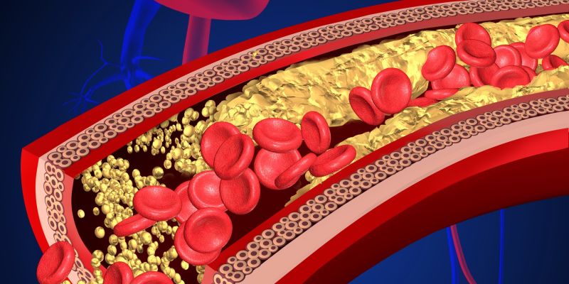 Srčno-žilne boletni, žile, holesterol