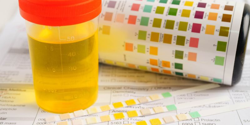 Analiza urina, vzorec, test