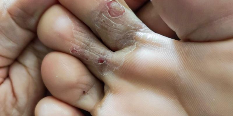 glivice, atletsko stopalo