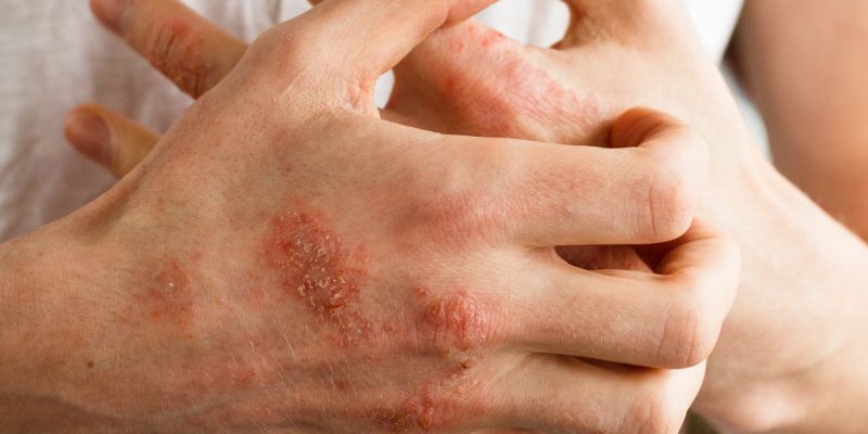 detergenti, alergicna-reakcija