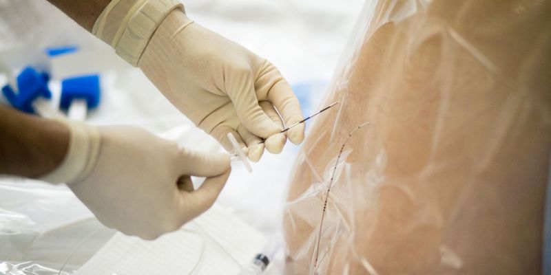 epiduralna, spinalna