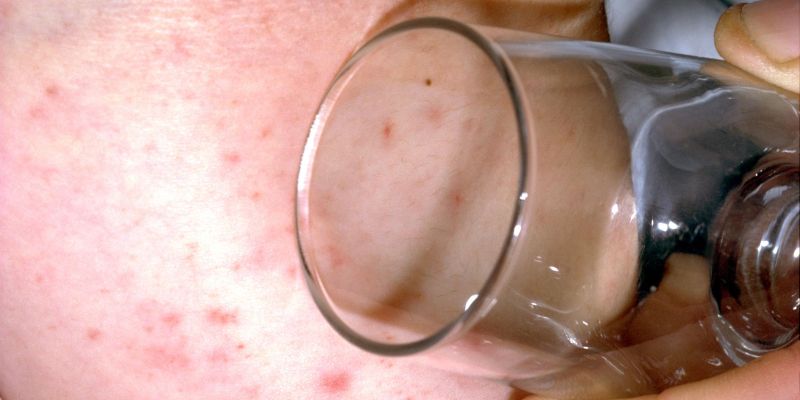 meningitis2 profimedia-0000869062.jpg