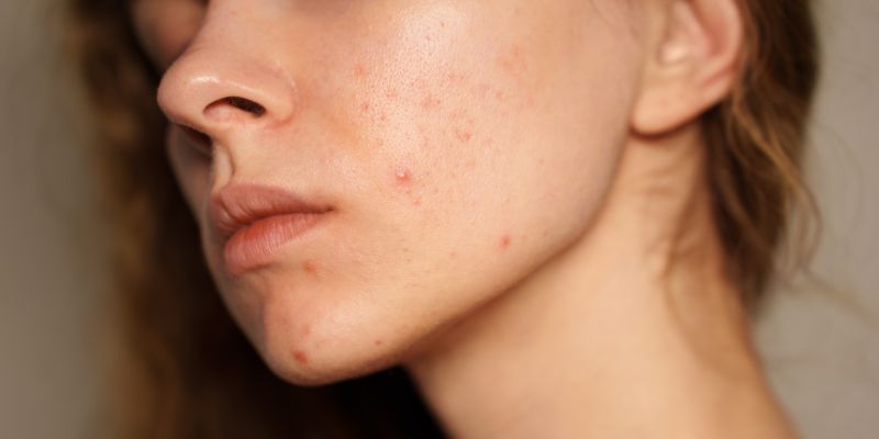 koža, puberteta, najstnica, mozolji, akne