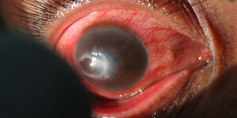 Akantamebni keratitis.jpg