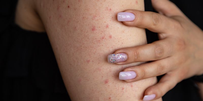 keratosis-pilaris