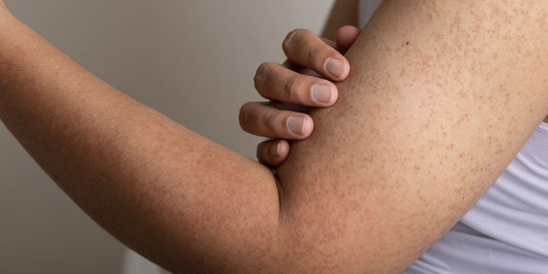 keratoza pilaris, pikice, roke, izpuščaji, koža