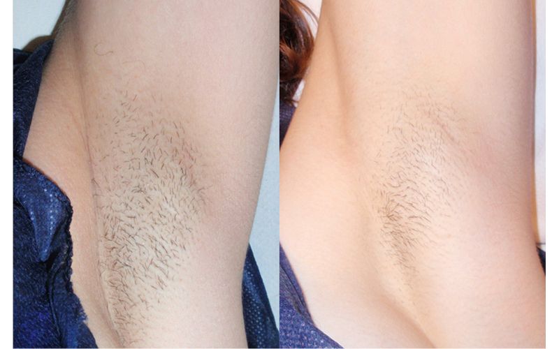 Armpits_before and after.jpg