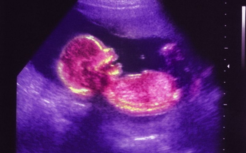 zarodek, fetus