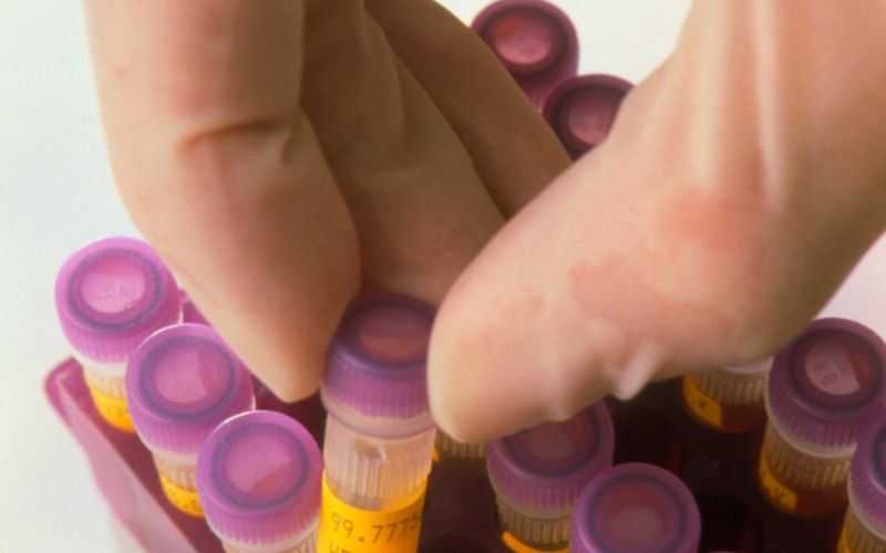 hepatitis c, hepatitis b, testiranje