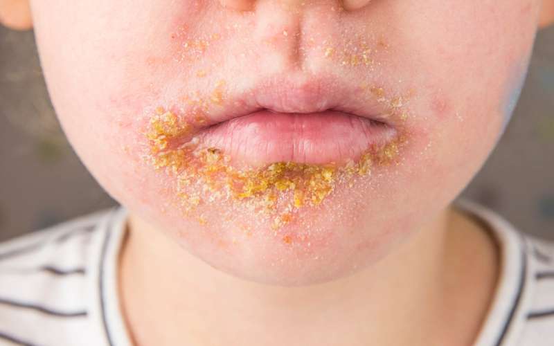 impetigo (1).jpg