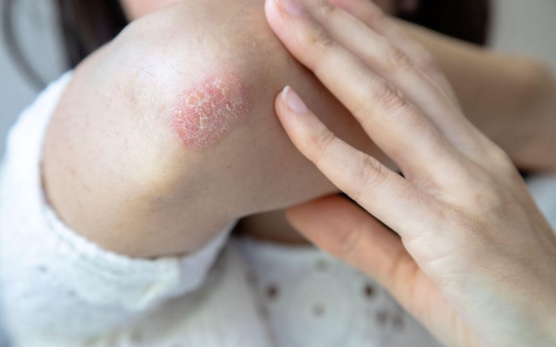 luskavica, suha koža