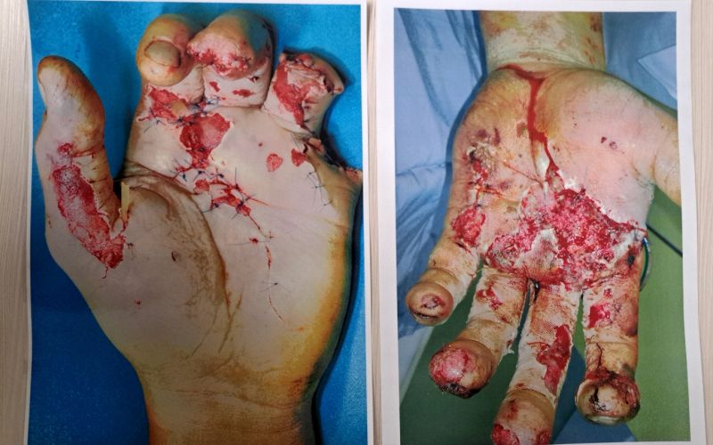 pirotehnika poškodbe.jpg