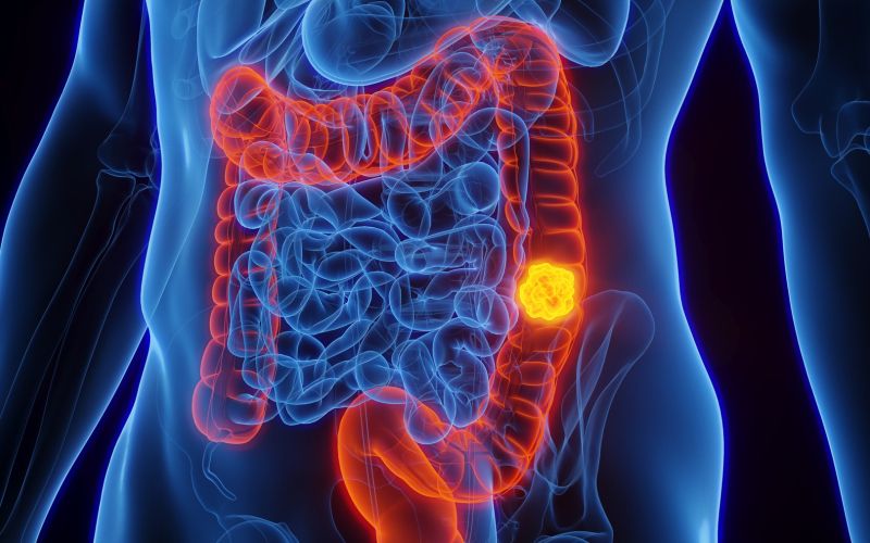 Rak debelega črevesa