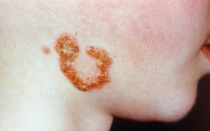impetigo (2).jpg
