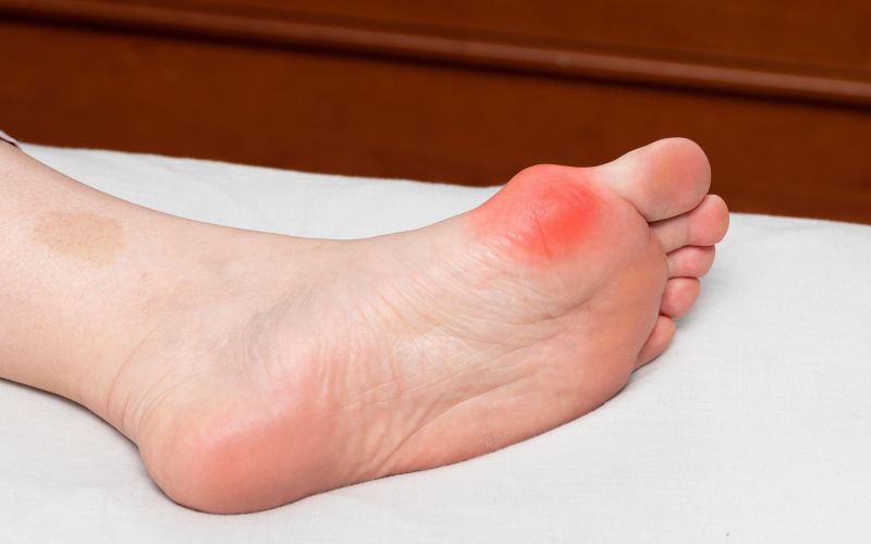 hallux valgus, izkrivljen nožni palec