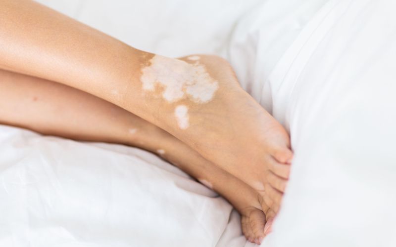 vitiligo