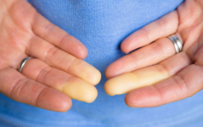 skleroderma