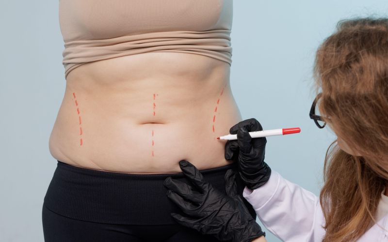 liposukcija
