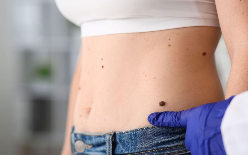 dermatolog, pregled, zdravnik, znamenje