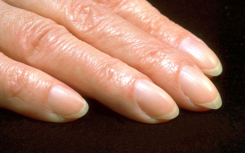 betičasti prsti, nohti