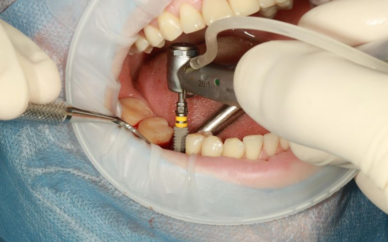 implantat