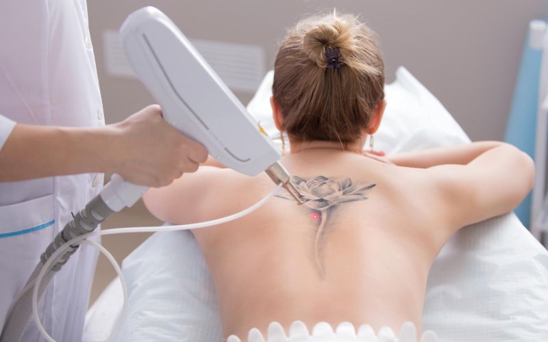 Odstranitev tetovaže