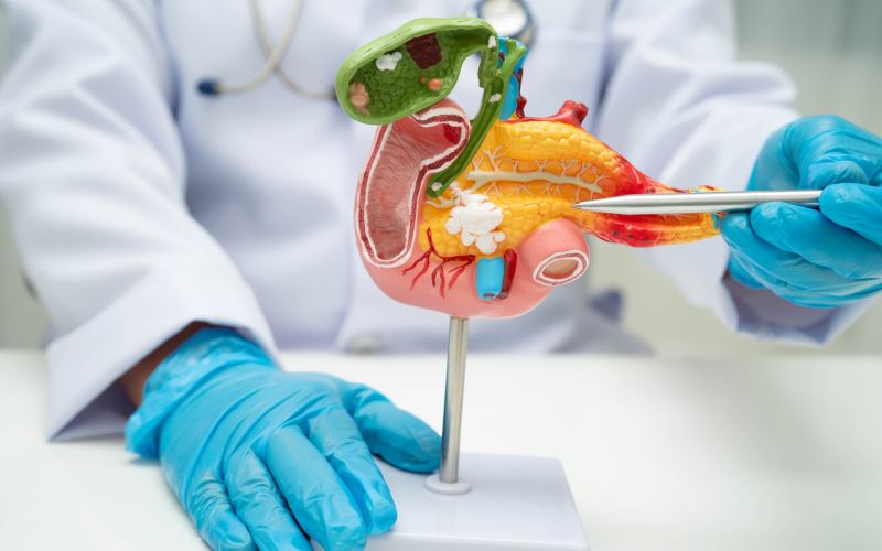 Rak trebušne slinavke