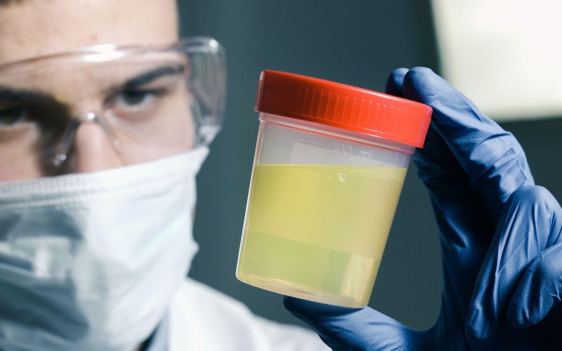 test urina, vzorec urina