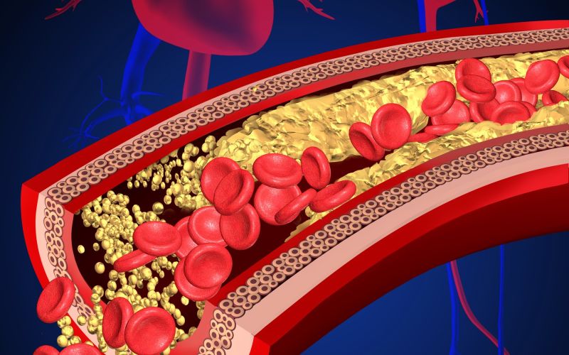 Srčno-žilne boletni, žile, holesterol