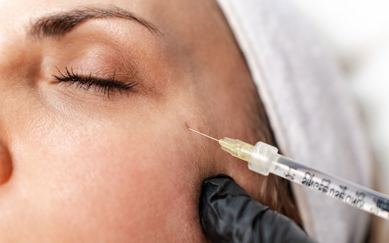 Injiciranje botulinum toksina.jpg