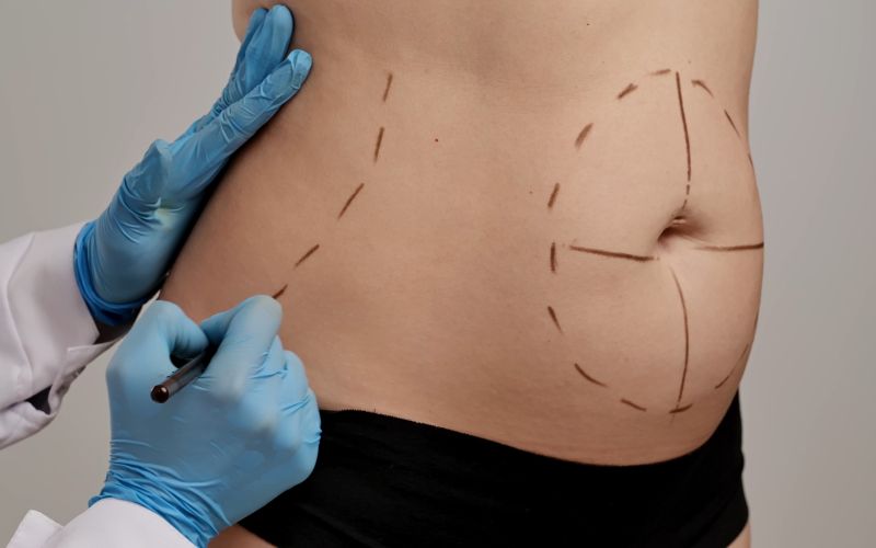 liposukcija, poseg (1).jpg