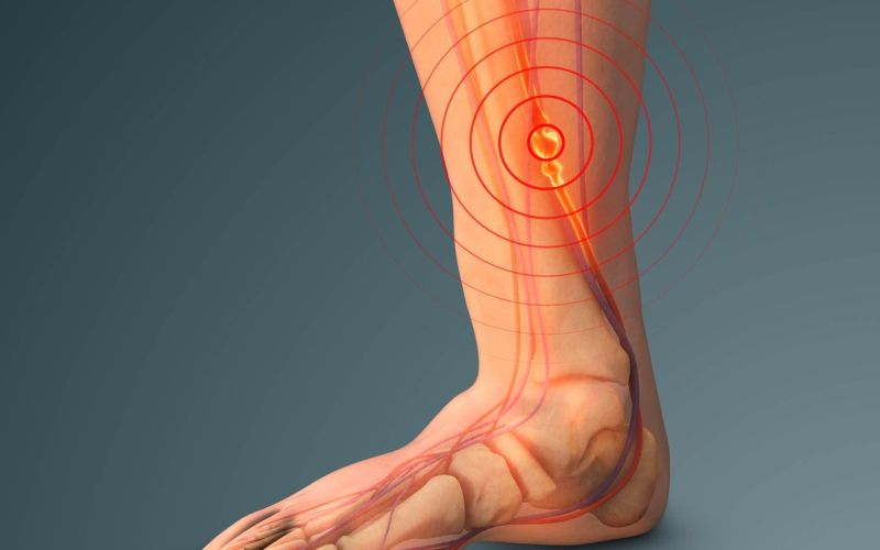 krvni strdek v nogi, globoka venska tromboza
