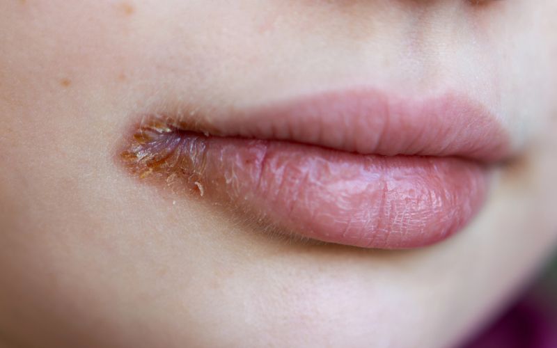 razpoke, ustnice, kotički ustnic