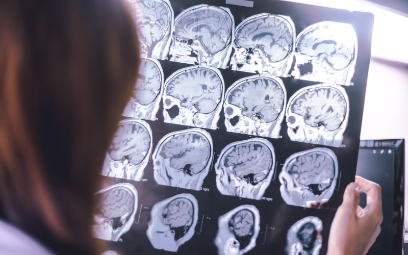 Frontotemporalna demenca (2).jpg