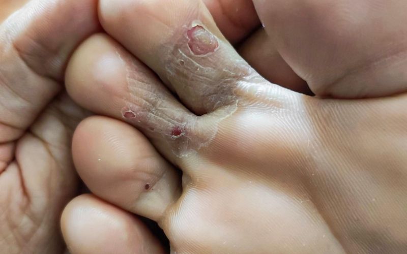 glivice, atletsko stopalo