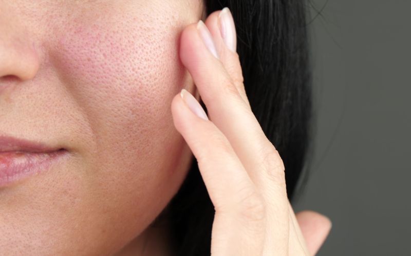 rdečica, koža, kožna bariera