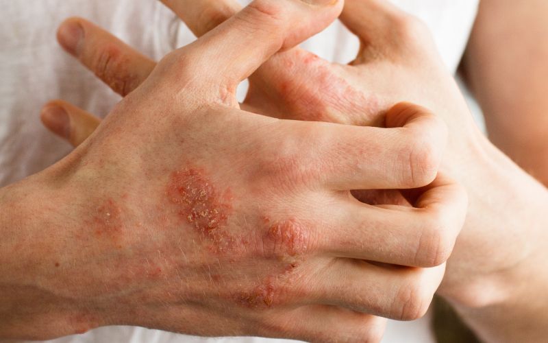 detergenti, alergicna-reakcija