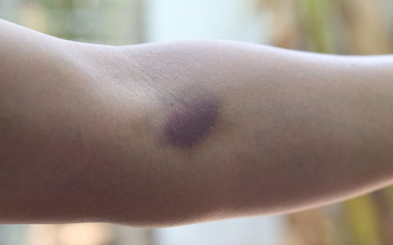 modrica, odvzem krvi