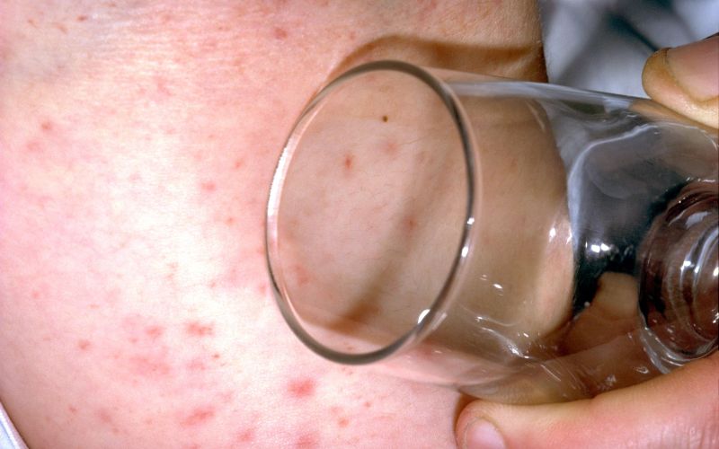 meningitis2 profimedia-0000869062.jpg