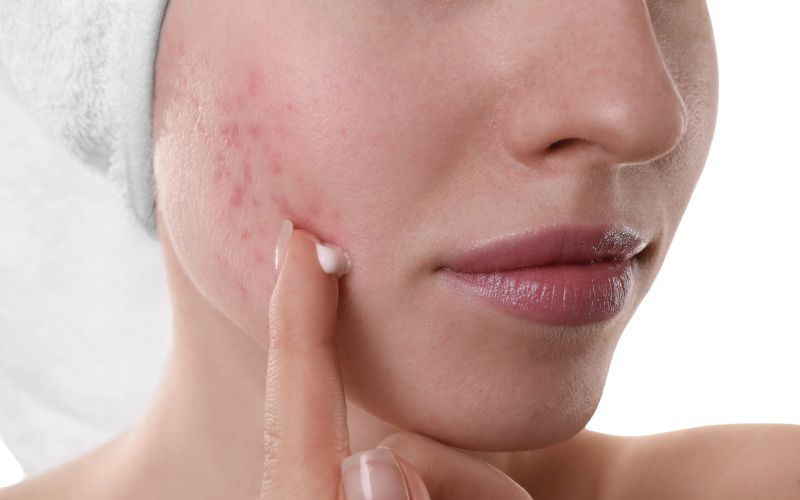 občutljiva koža, nega.jpg