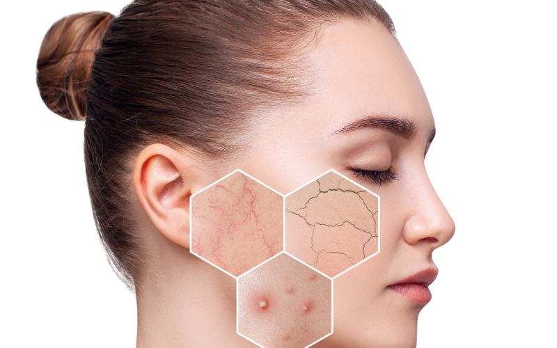 različni tipi kože.jpg