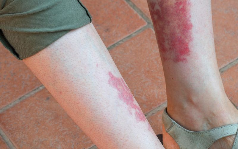 Vaskulitis, izpuščaj